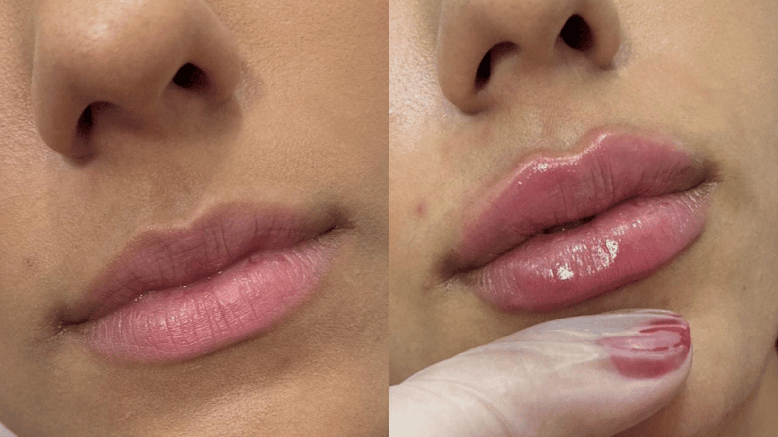 Preenchimento Labial Antes e Depois: Veja Resultados