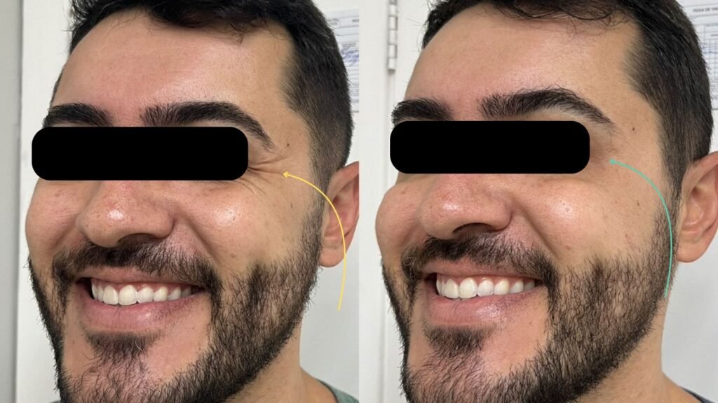 Foto de antes e depois do Botox realizado na clínica My Beleza