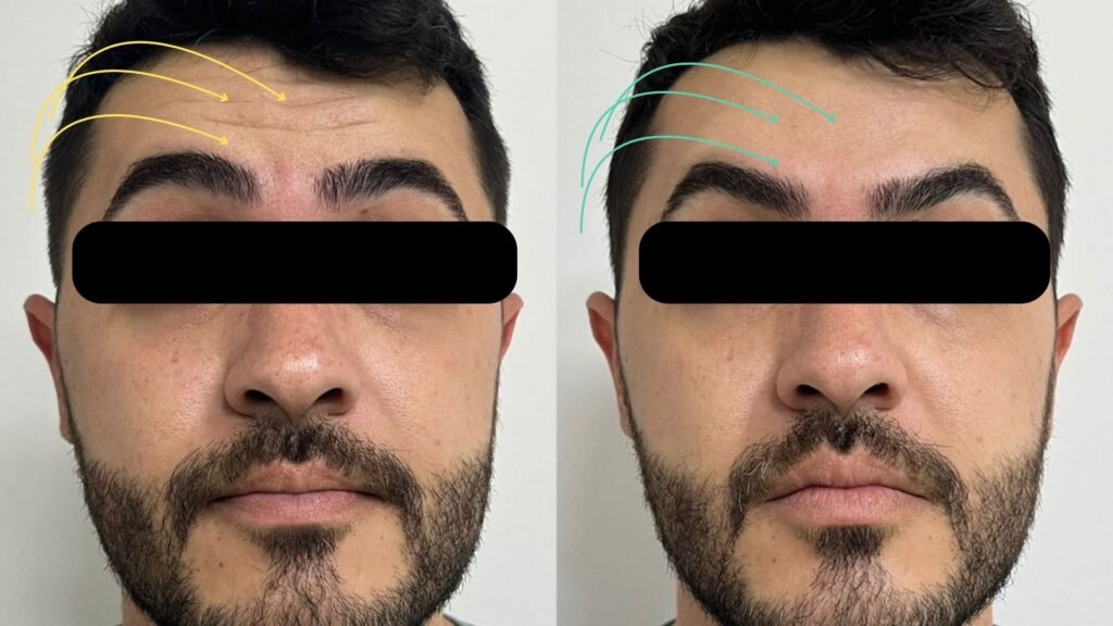 Foto de antes e depois do Botox realizado na clínica My Beleza