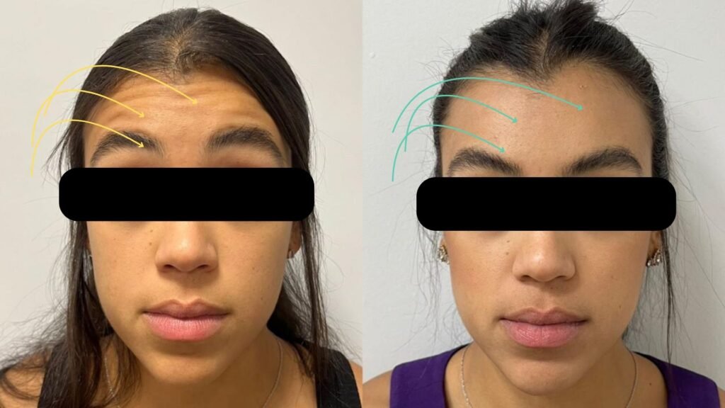 Foto de antes e depois do Botox realizado na clínica My Beleza